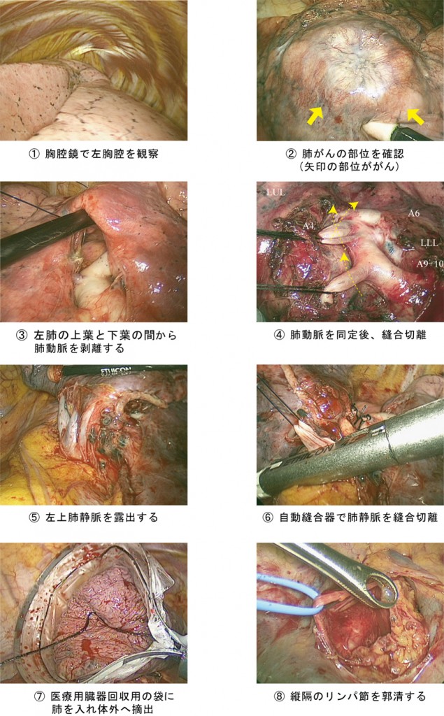 胸腔鏡下手術の流れ